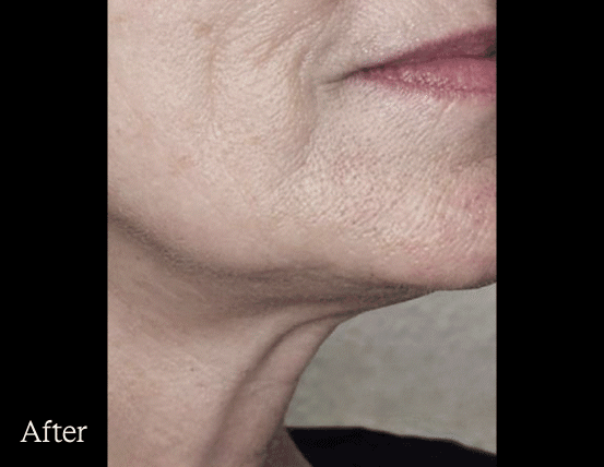 Before & after DENSITY treatment