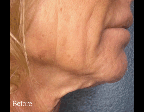 Before & after DENSITY treatment