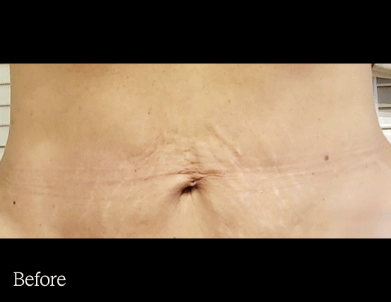 Before & after DENSITY treatment